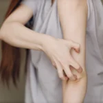 Voici comment sont les mécanismes de l'allergie cutanée